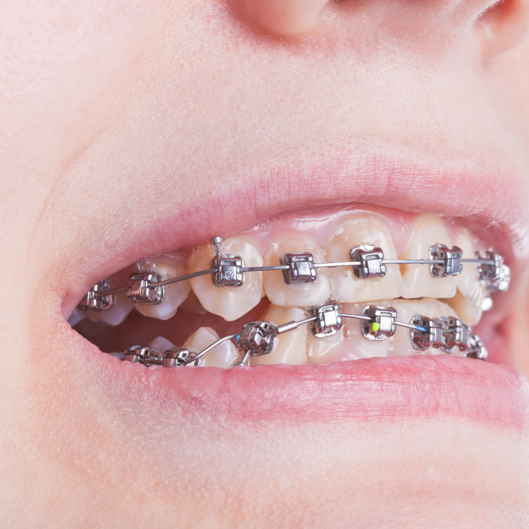 Braces and Orthodontic Treatment
