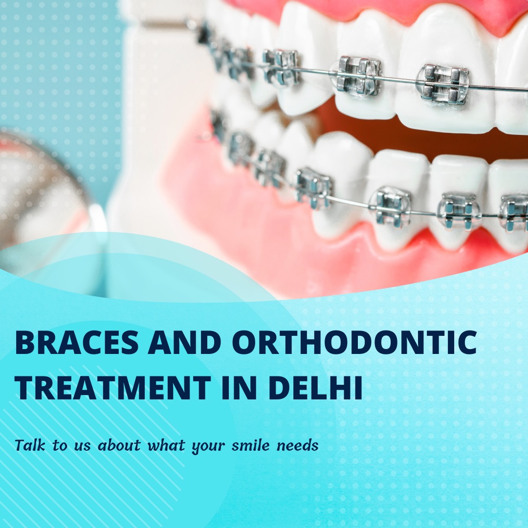 Braces and Orthodontic Treatment in Delhi